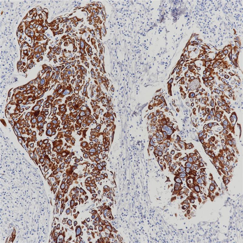 宫颈鳞癌 CK (HMW)(BP6021&BP6077) 染色