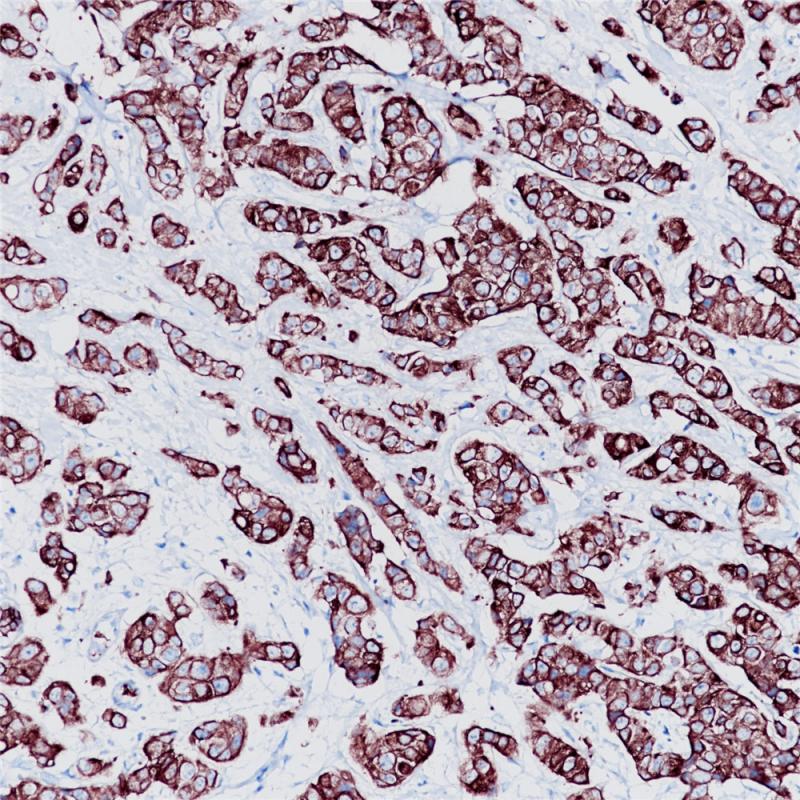 乳腺癌 CK7 (BP6060) 染色