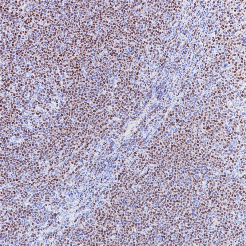 弥漫大B细胞淋巴瘤 MUM1 (BP6094) 染色