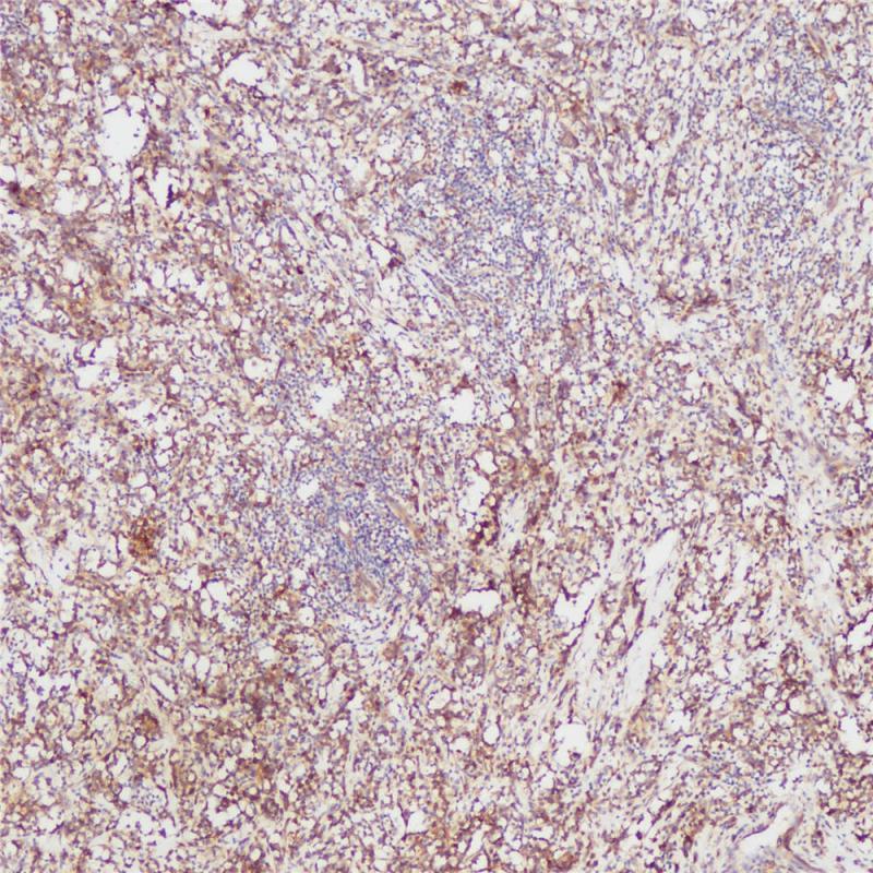 浆细胞瘤 CD138 (BP6035) 染色
