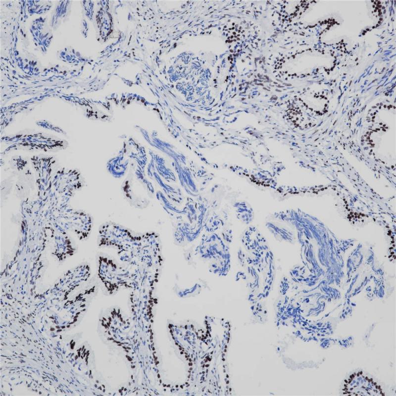 前列腺癌 AR (BP6126) 染色