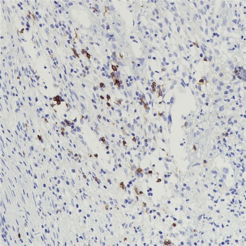 结肠癌 CD25 (BP6120) 染色