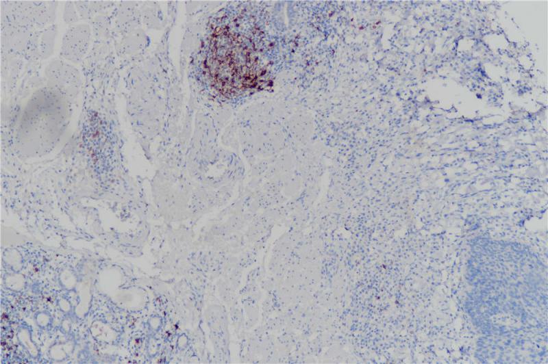 子宫 CD23 (BP6049) 染色