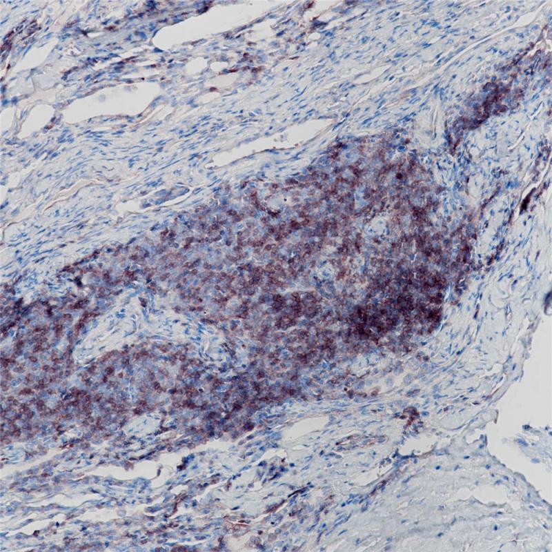 胸腺瘤 CD1a (BP6055) 染色