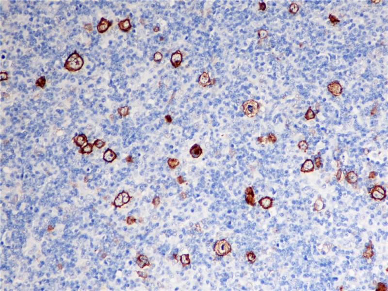 霍奇金淋巴瘤 CD30 (BP6012) 染色