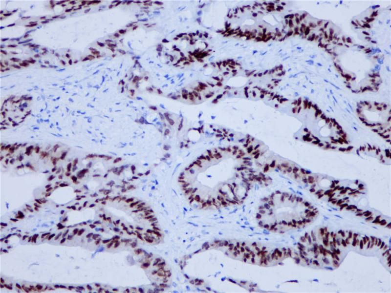 结肠腺癌 CDX2 (BP6023) 染色