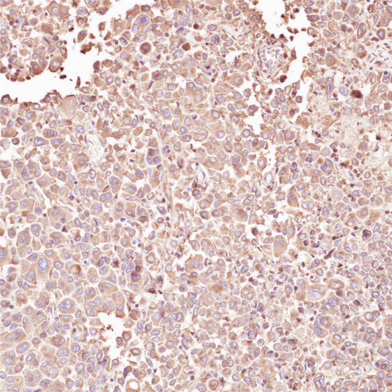 胃癌 CEA (BP6085) 染色