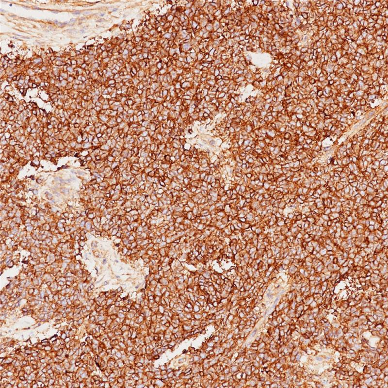 尤文肉瘤 CD99 (BP6013) 染色
