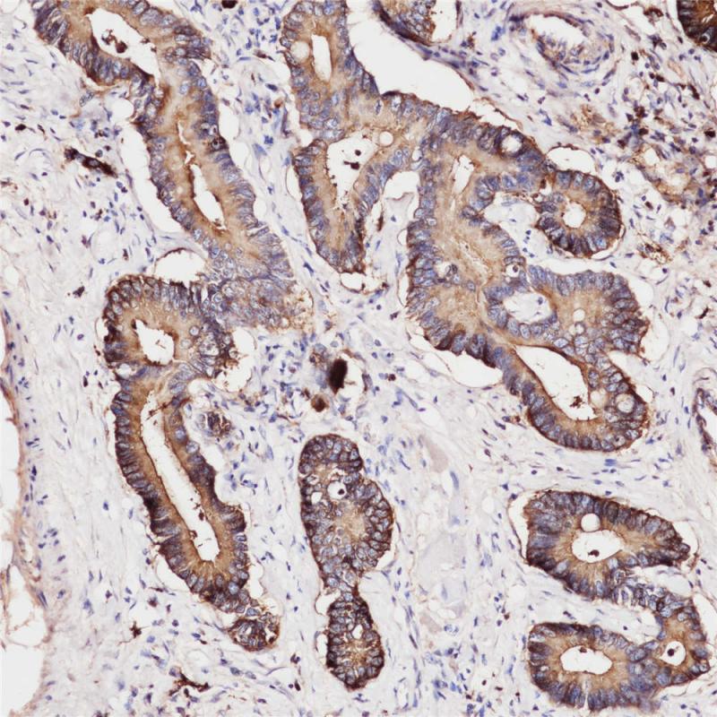 结肠癌 CEA (BP6085) 染色