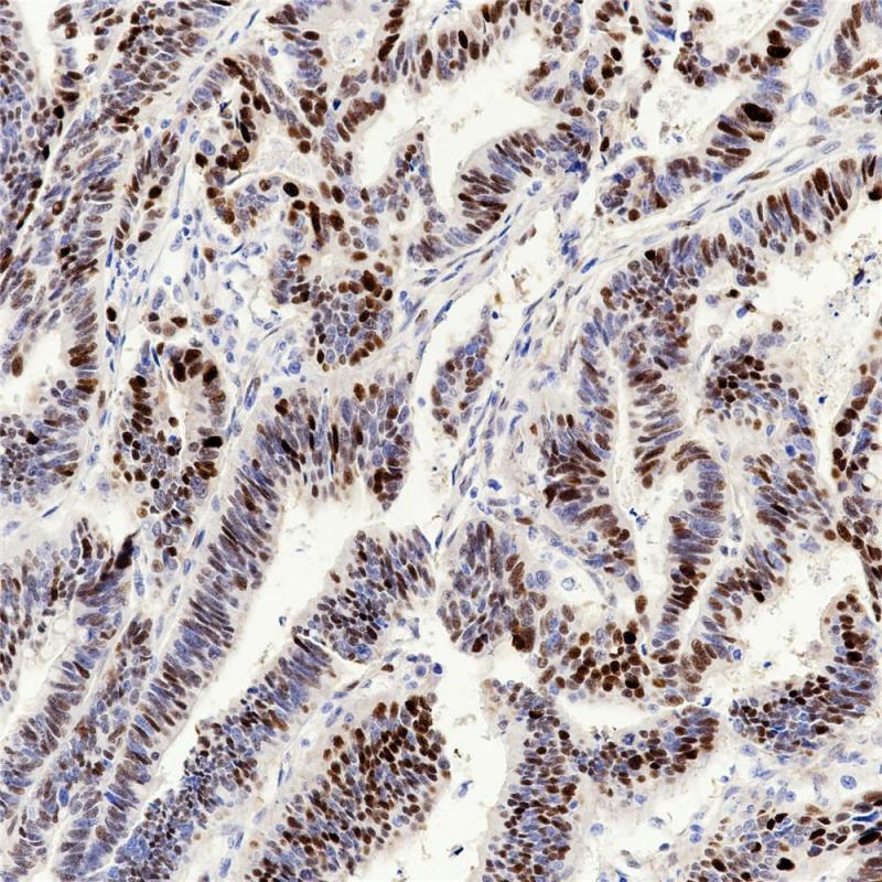 结肠癌 Cyclin D1（BP6076）染色