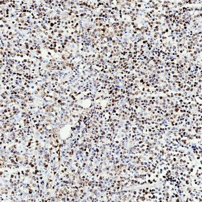 套细胞淋巴瘤 Cyclin D1（BP6076)染色