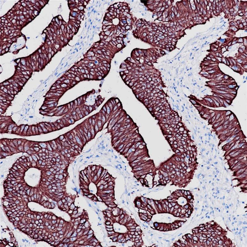 结肠腺癌 CK18 (BP6054) 染色