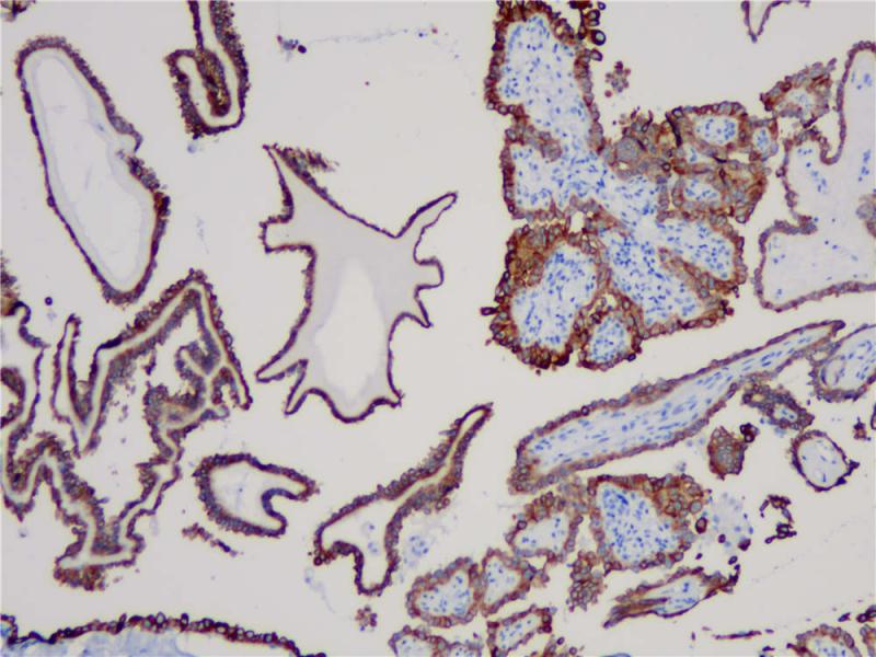 甲状腺癌 CK19 (BP6022) 染色