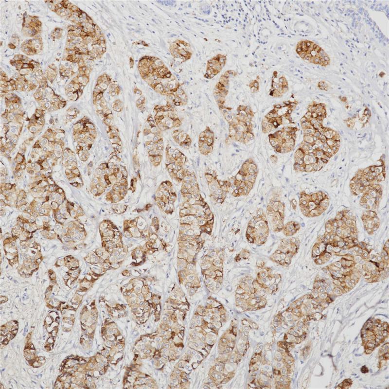 乳腺癌 GCDFP-15 (BP6118) 染色