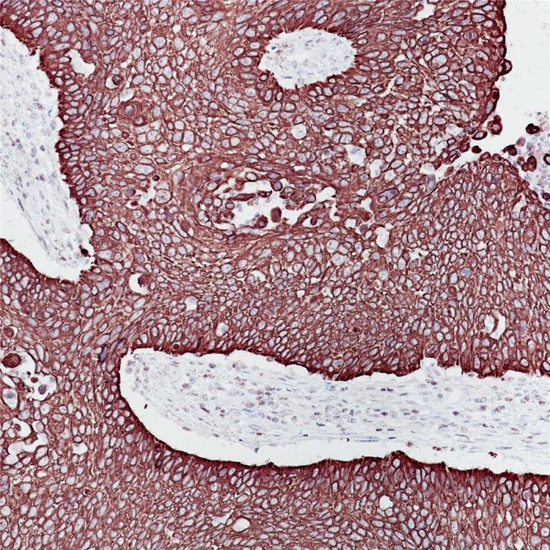 食管癌 CK6 (BP6065) 染色
