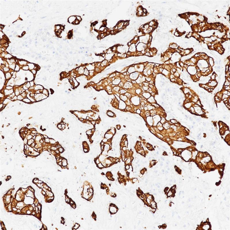 肺腺癌 CK8 (BP6005) 染色