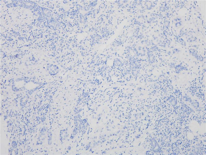 乳腺癌 HER2(-) (BP6020) 染色