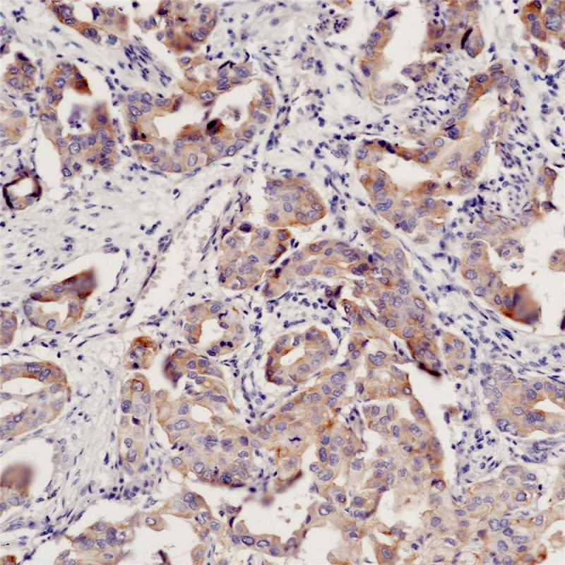 肺癌 EGFR (L858R)(BP6098) 染色