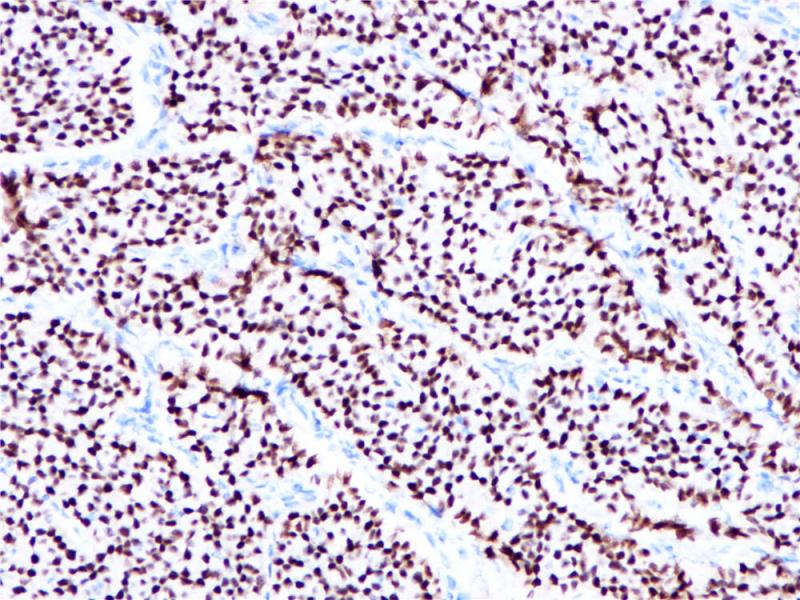 乳腺癌 ERα(+) (BP6026) 染色