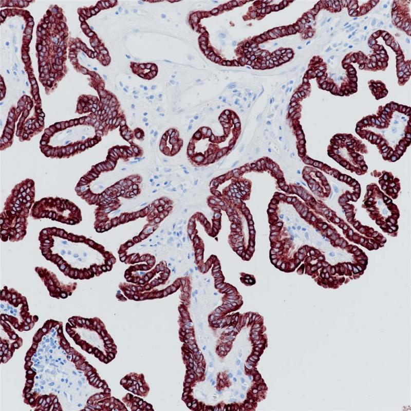 甲状腺癌 CK7 (BP6060) 染色