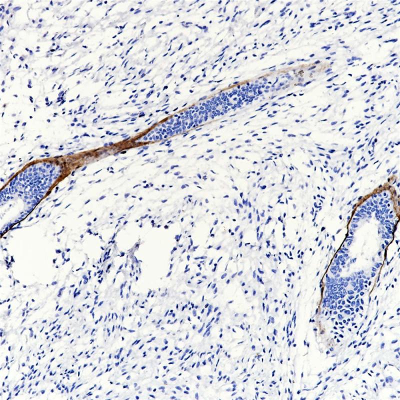 子宫内膜癌 HPL (BP6114) 染色