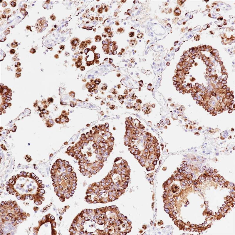 肺腺癌 Napsin A (BP6083) 染色