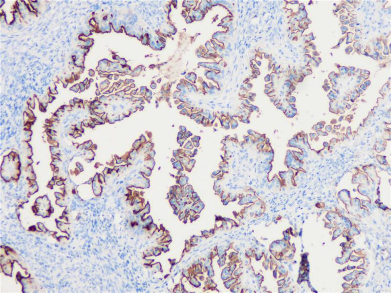 卵巢癌 MUC1 (BP6034) 染色