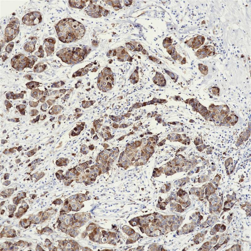 乳腺癌 RRM1 (BP6122) 染色