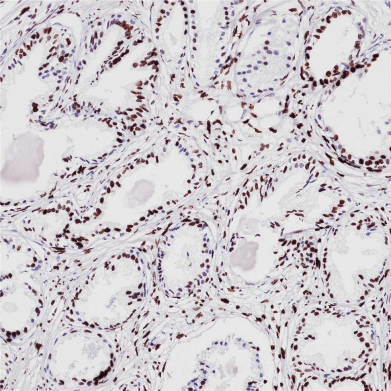前列腺癌PHH3(BP6092)染色