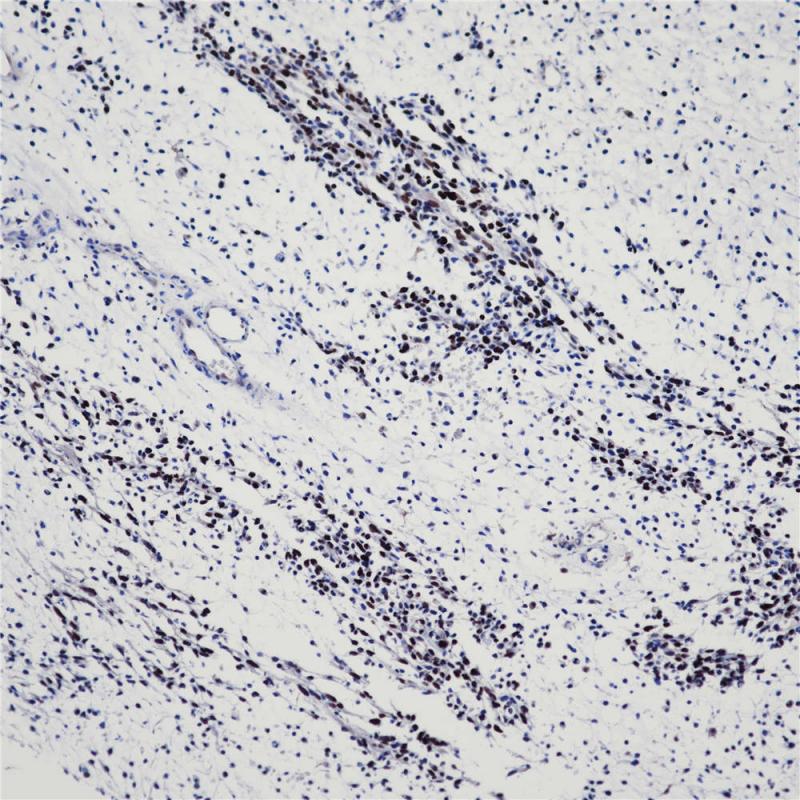 横纹肌肉瘤 MyoD1 (BP6124) 染色