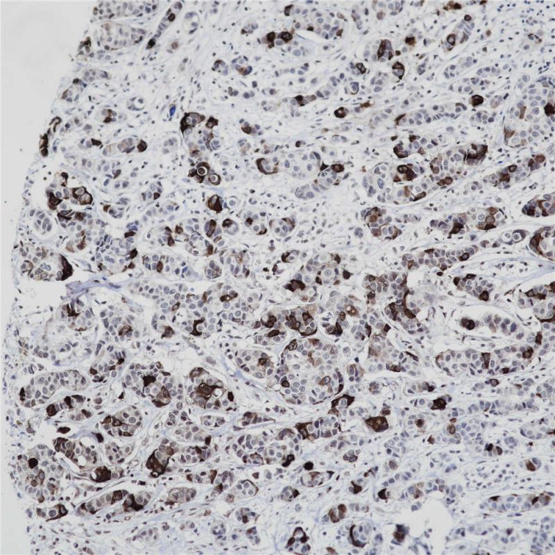 乳腺癌 Mammaglobin (BP6125) 染色