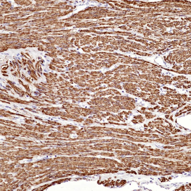 平滑肌瘤 Myosin,Smooth Muscle (BP6091)染色