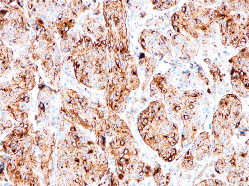 黑色素瘤 PMEL17 (BP6031) 染色