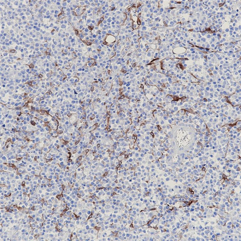 弥漫大B淋巴瘤 Podoplanin (BP6110) 染色
