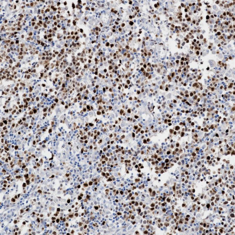 弥漫性大B细胞淋巴瘤 MUM1 (BP6094) 染色