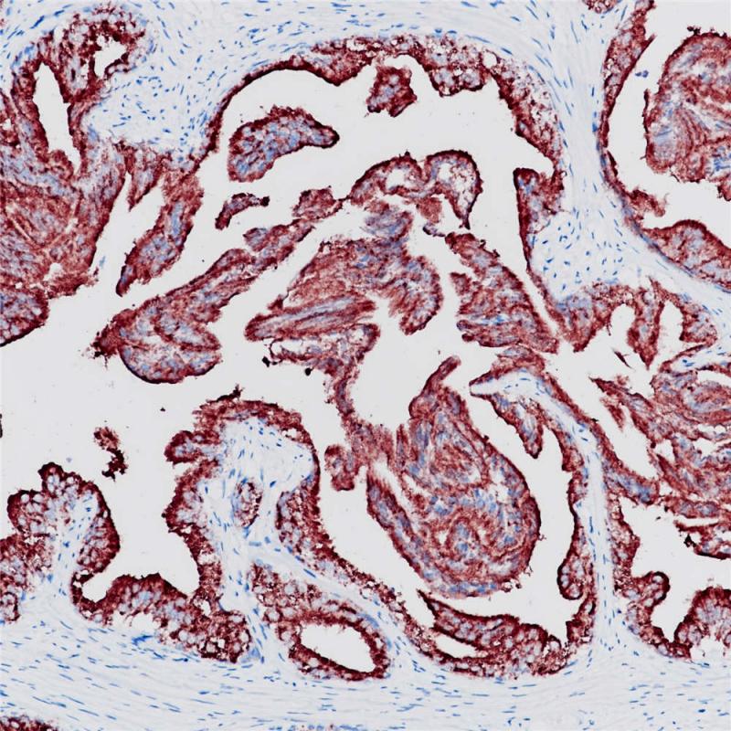 前列腺癌 PSAP (BP6050) 染色