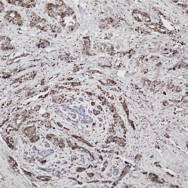 乳腺癌 Mammaglobin (BP6125) 染色