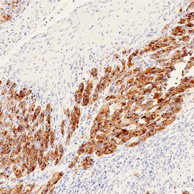 黑色素瘤 PMEL17 (BP6031) 染色
