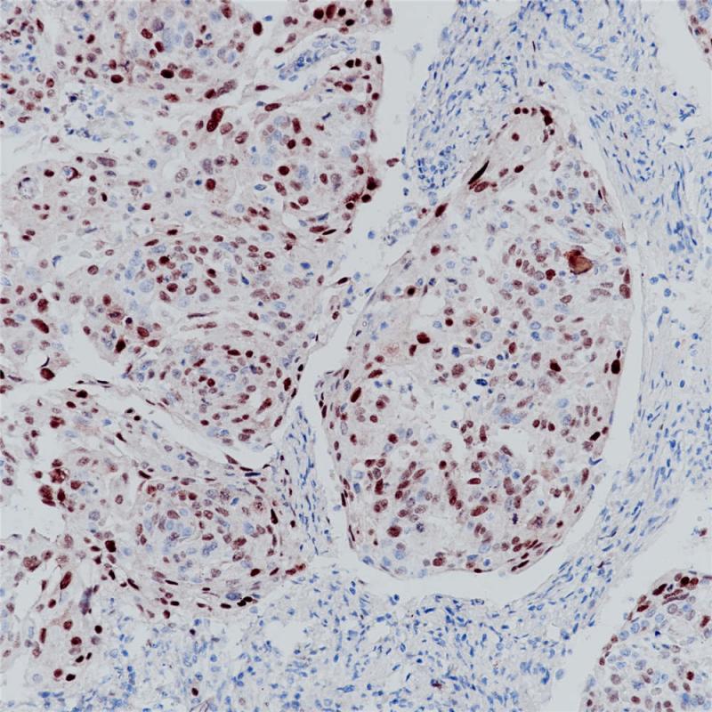 宫颈癌 p21 (BP6068) 染色