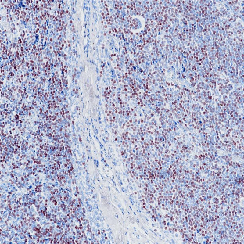 套细胞淋巴瘤 SOX-11 (BP6070) 染色