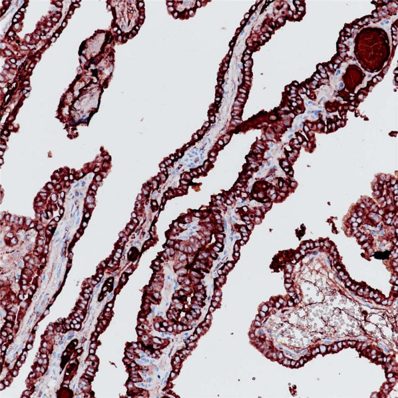 甲状腺癌 Thyroglobulin (BP6067) 染色