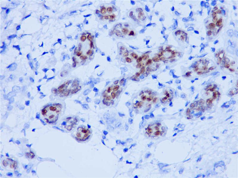乳腺癌SOX-10(BP6024)染色