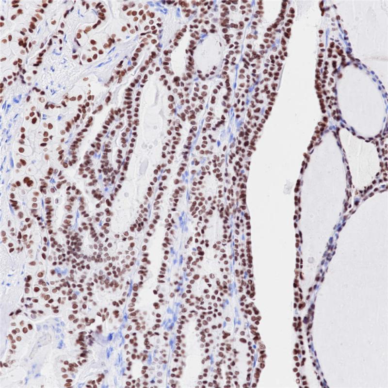 甲状腺癌 TTF-1 (BP6079) 染色