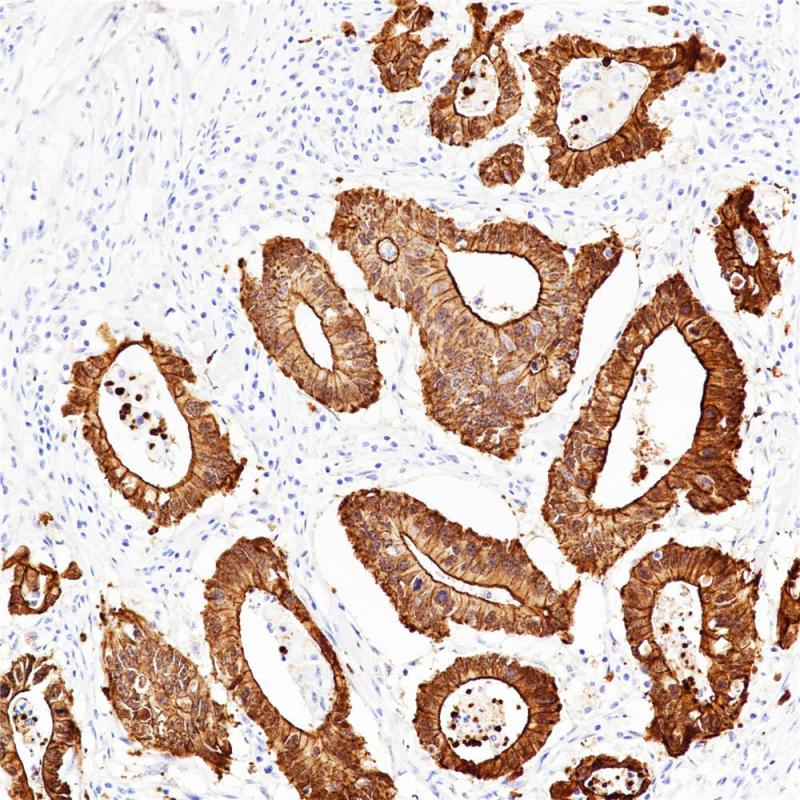 结肠腺癌 Villin (BP6066) 染色