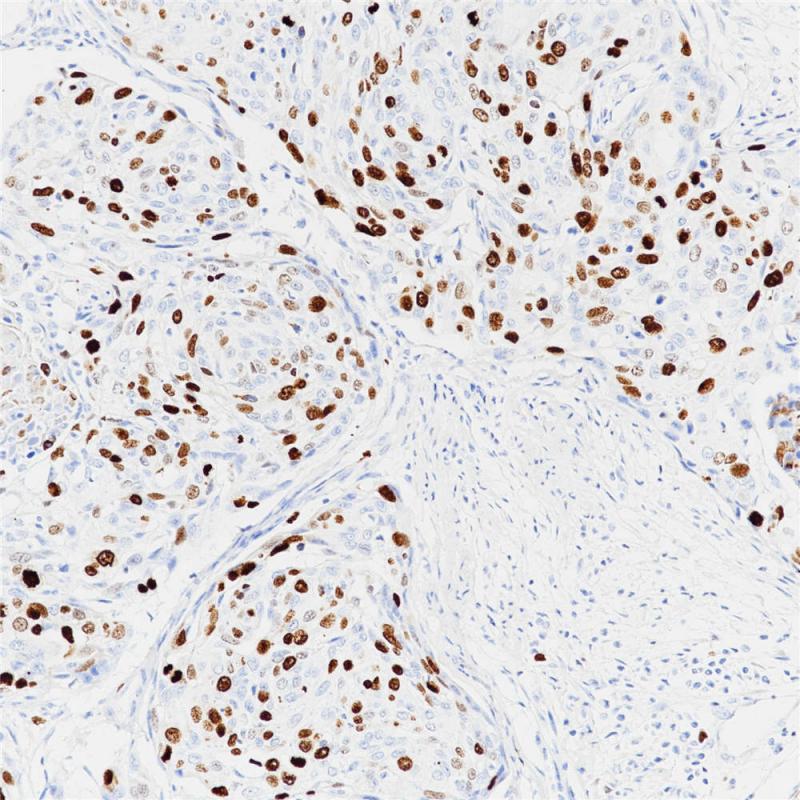 宫颈癌 Topoisomerase Ⅱ-α (BP6016) 染色