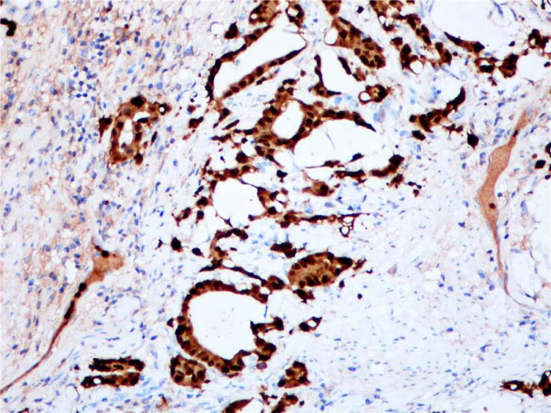 胃腺癌S100P(BP6018)染色