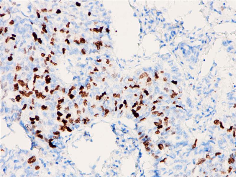 肺癌 Topoisomerase Ⅱ-α (BP6016) 染色