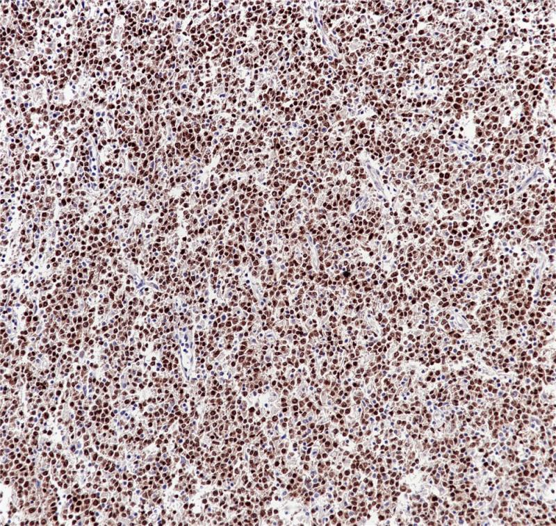 弥漫大B淋巴瘤 PAX-5（BP6140）染色