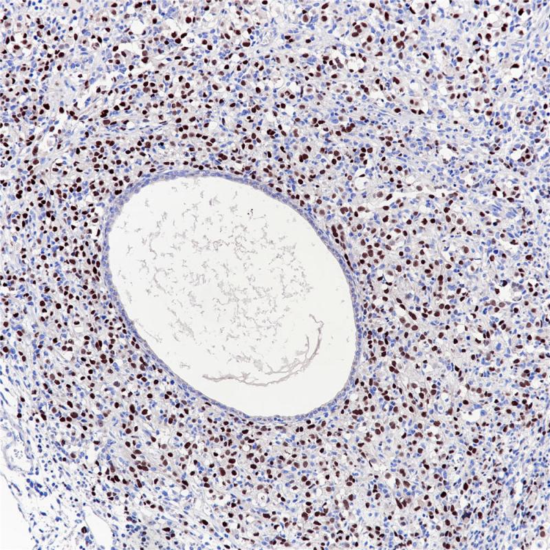 胚胎型横纹肌肉瘤 Myogenin（BP6137）染色