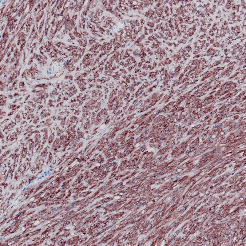 胃肠道间质瘤 CD117 (BP6064) 染色